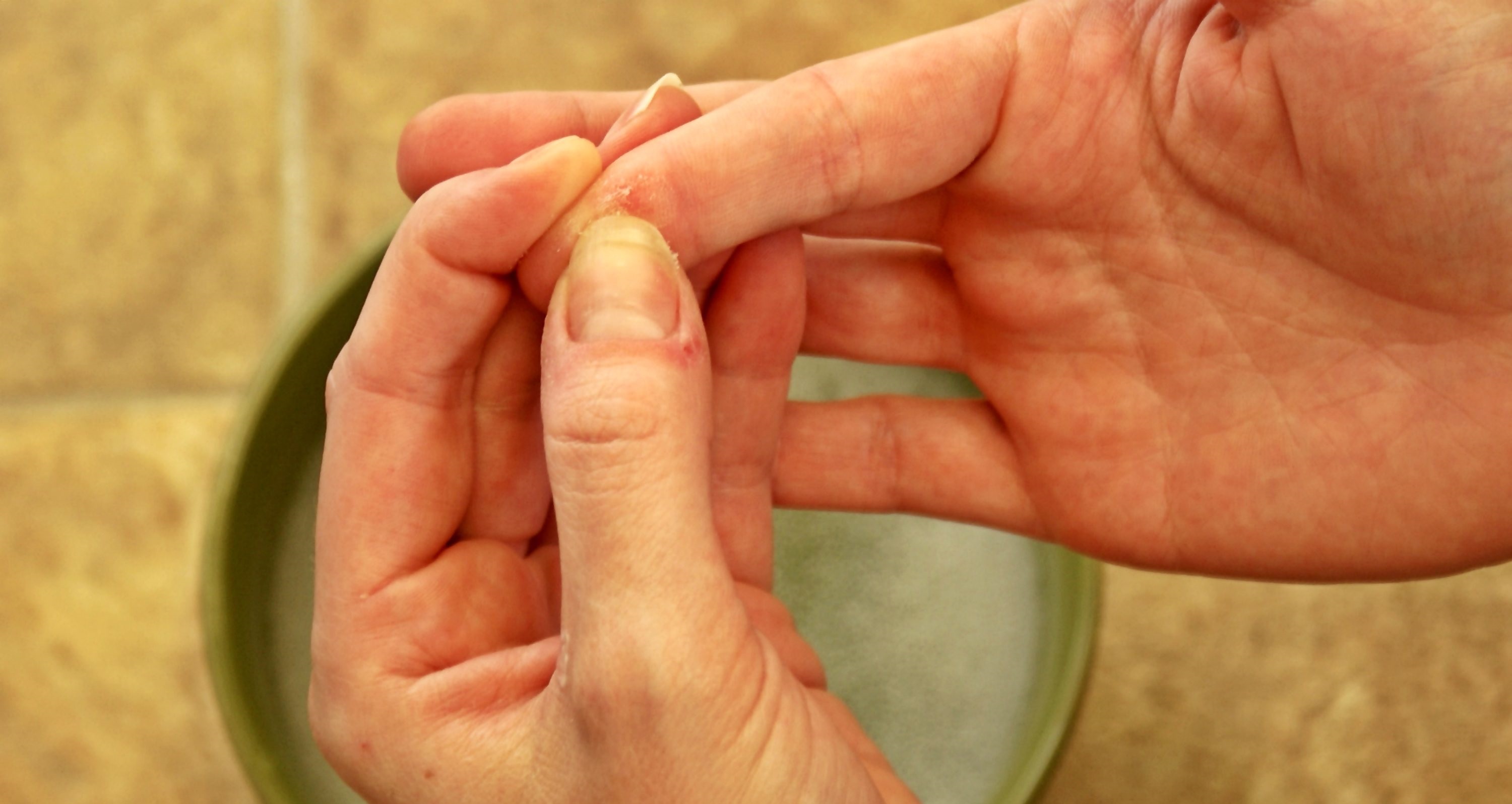 glass wool got on the skin